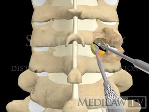 Cervical Spine Facet Joint Foraminotomy with burring orthopedic 3D animations
