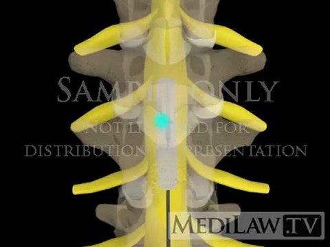Lumbar Spinal Cord Neuro-stimulation paddle electrode pain management animations