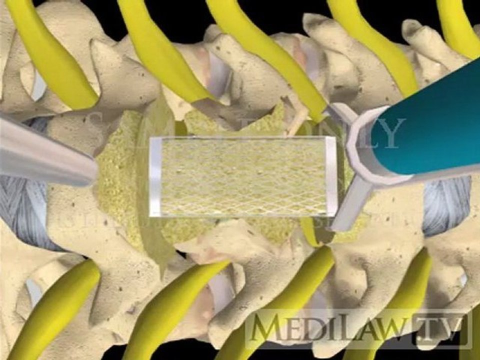Cervical Spine Vertebrectomy Corpectomy with cage + plate orthopeadic 3D animations
