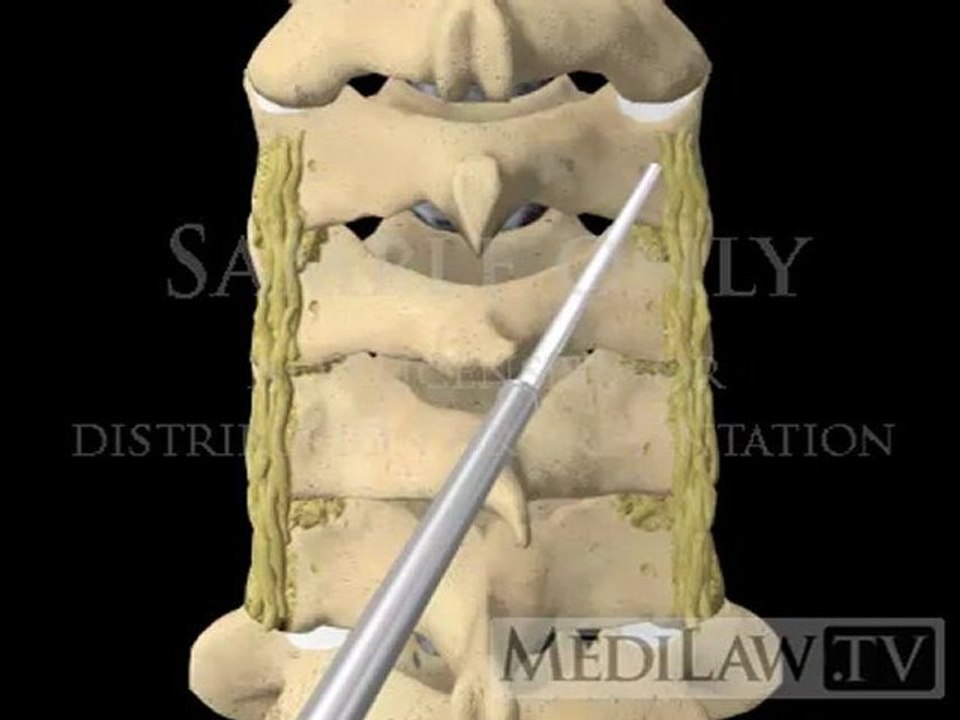 Cervical Spine Lateral Mass Screw Fusion Fixation neuro-surgical videos