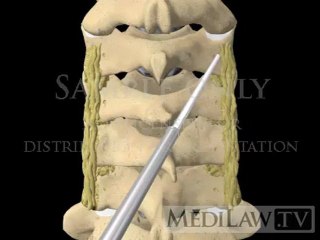 Cervical Spine Lateral Mass Screw Fusion Fixation neuro-surgical videos