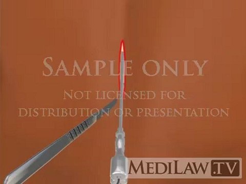 Lumbar Spinal Cord Stimulation Wire Electrode Implantation neurosurgical multimedia