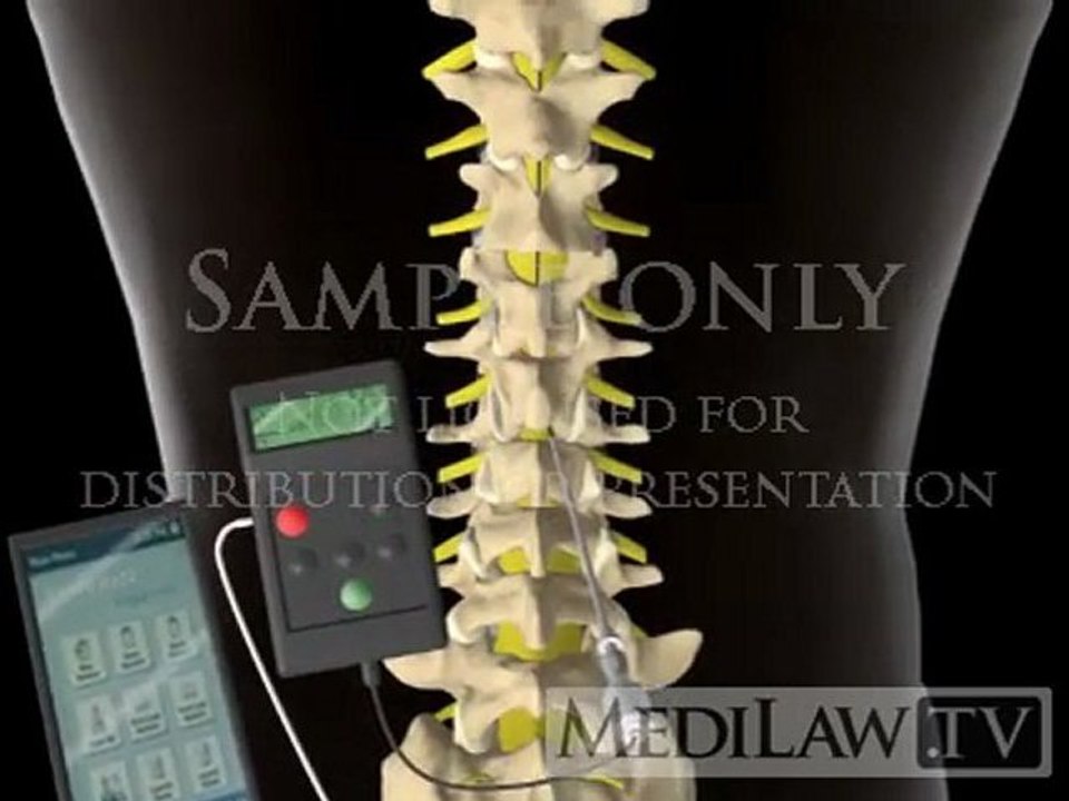 Lumbar Spinal Cord Trial Stimulation wire electrode neuro-surgery animations