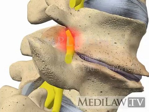 Lumbar Spine Movement Intervertebral Degenerative Disc Disease chiropractor 3D animations