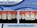 Dentist Apex NC | Implant Dentistry Apex NC | Dental Clinic Apex NC