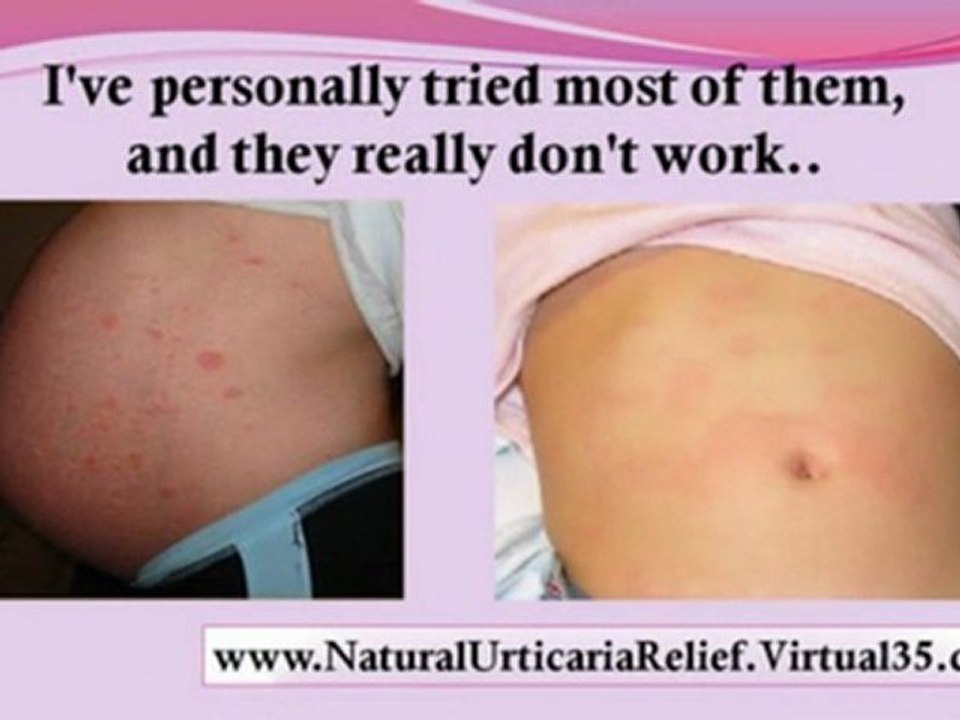 hypocomplementemic urticarial vasculitis - cholinergic urticaria treatment - urticaria diet