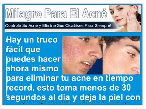 Como Curar y Eliminar Barros y Espinillas en Casa