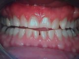 Porcelain Veneers- Dental Restoration- Austin Tx, Lakeway Dentist