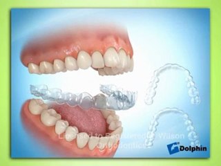 Invisalign & Invisalign Teen FAQ's - Gainesville GA