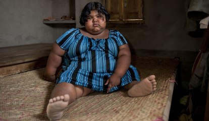 Suman Khatun, One Of The Fattest Kids In The World