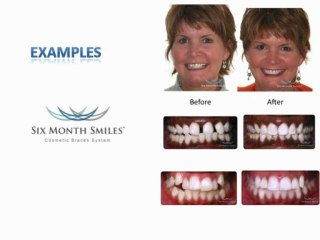 Adult Braces | 6 Month Cosmetic Braces