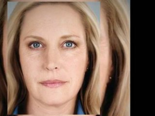 What is Sculptra? Los Angeles Treatment Info