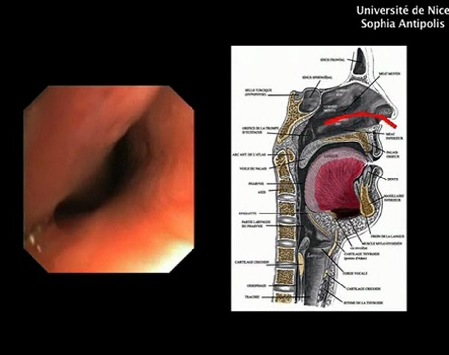 Fibroscopie bronchique