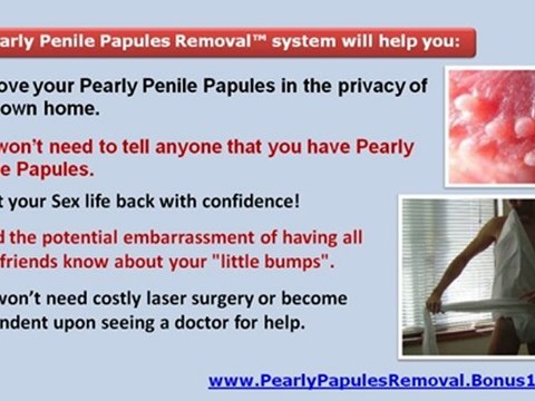 pearly penile papules - pearly penile papules removal at home - sebaceous glands penis