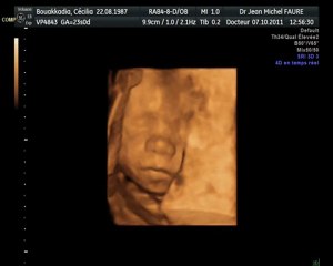 Echographie du 2nd trimestre Evan