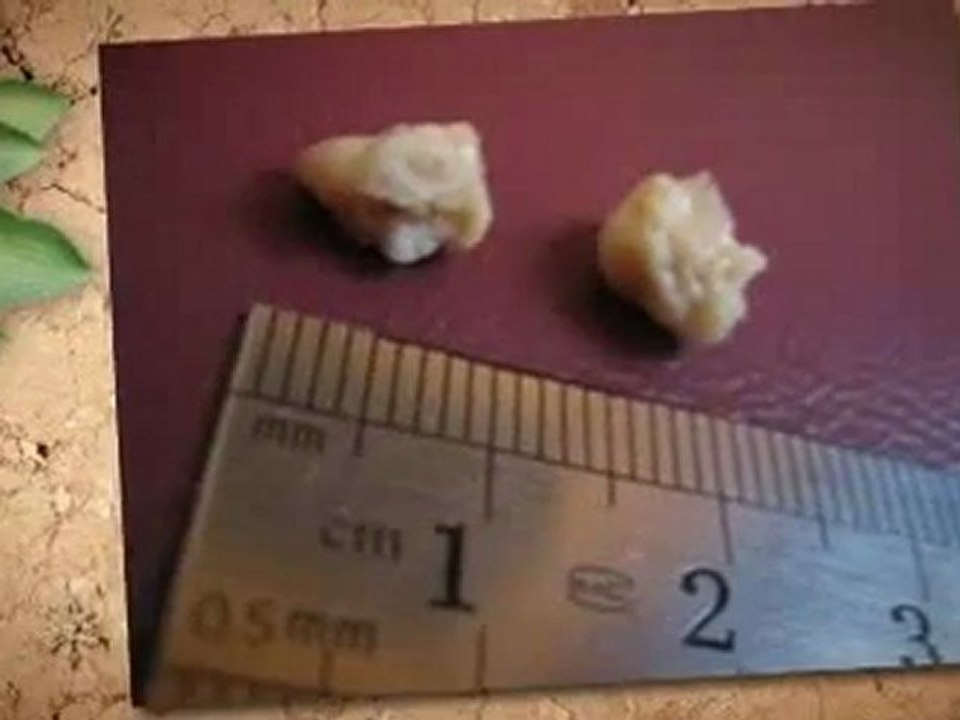 Tonsil Stones - Yucky