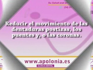Que son los implantes dentales