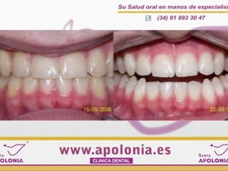 Tecnicas de blanqueamiento dental
