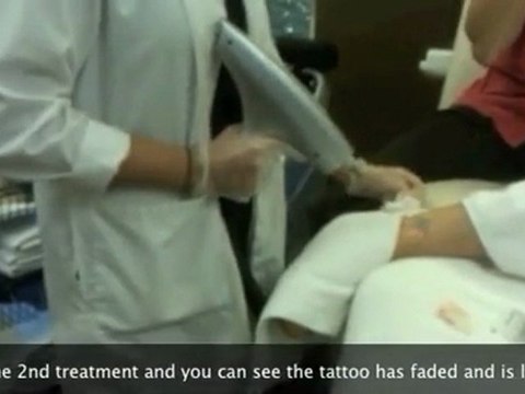 Huntsville Laser Tattoo Removal, Sunburst on Ankle 6