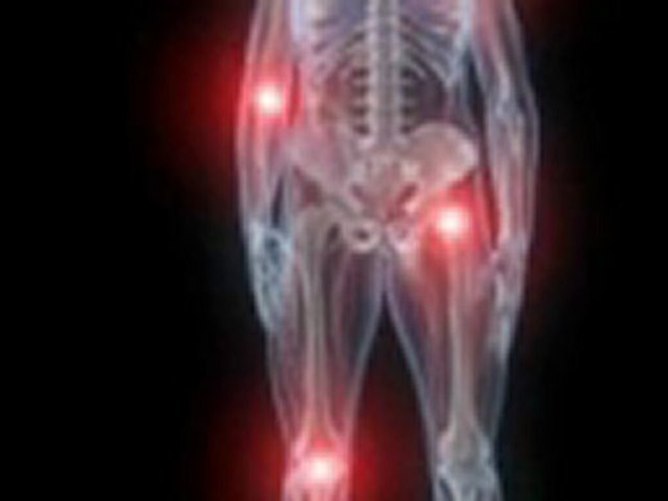 Information On Uric Acid Gout
