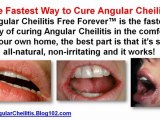 treatment for angular cheilitis - angular cheilitis remedy