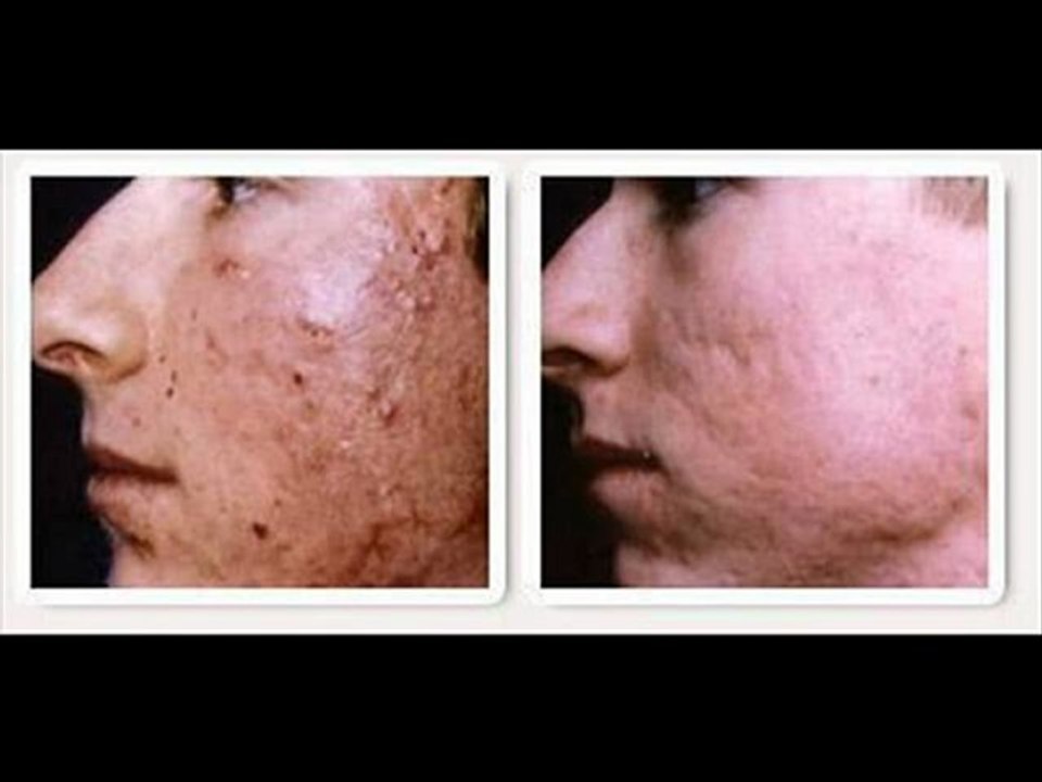 Eliminar Acne para siempre - quitar espinillas