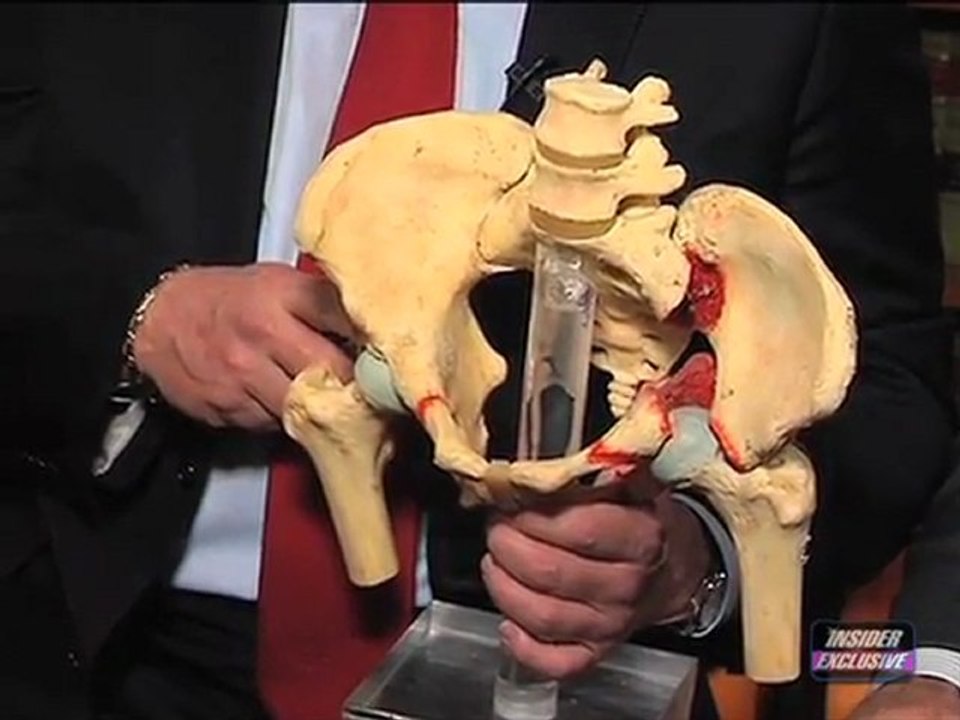 An over-dosage of corticosteroids causes Two Hip Replacements for 25 y.o. Medical Mistakes-Pt.2.