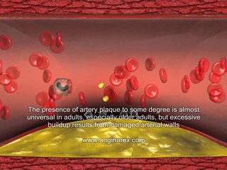 Artery Plaque Build Up?