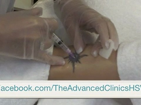 Huntsville Laser Tattoo Removal, Sunburst on Ankle 4