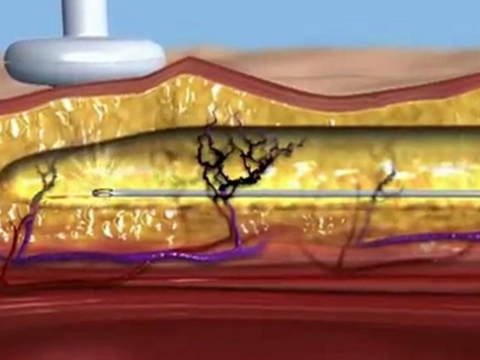 BodyTite bei SWISSESTETIX