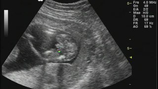Ultrasound Images of Twins