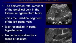 Ultrasound of the Liver part 2