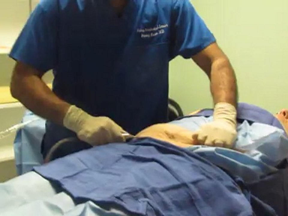 SmartLipo Laser Liposuction- Los Angeles County-Orange County-Riverside County-San Bernardino County-Inland Empire-Anaheim-Fullerton-Beverly Hills-Pasadena-Burbank-Hollywood-Cerritos-Long Beach-Irvine-Costa Mesa-Orange-Brea-Whittier-Pomona-Chino-Fontana