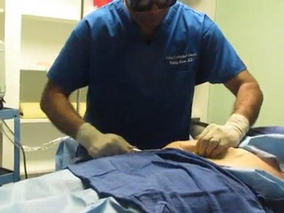 SmartLipo Laser Liposuction- Los Angeles County-Orange County-Riverside County-San Bernardino County-Inland Empire-Anaheim-Fullerton-Beverly Hills-Pasadena-Burbank-Hollywood-Cerritos-Long Beach-Irvine-Costa Mesa-Orange-Brea-Whittier-Pomona-Chino-Fontana