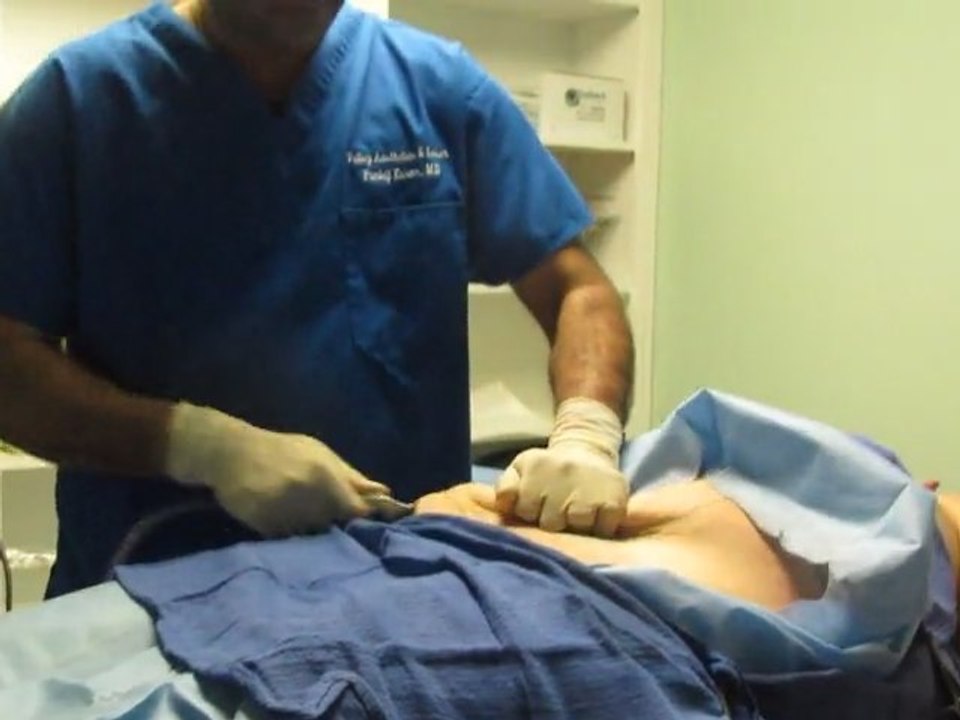 SmartLipo Laser Liposuction- Los Angeles County-Orange County-Riverside County-San Bernardino County-Inland Empire-Anaheim-Fullerton-Beverly Hills-Pasadena-Burbank-Hollywood-Cerritos-Long Beach-Irvine-Costa Mesa-Orange-Brea-Whittier-Pomona-Chino-Fontana