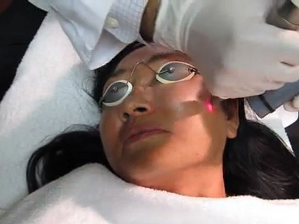 Laser Peel-Micro Laser Peel-Skin Resurfacing-Pasadena-Los Angeles-Santa Monica-Irvine-Brea-Whittier-Covina-Fullerton-Anaheim-Cerritos-Yorba Linda-Hacienda Heights-La Habra-Long Beach