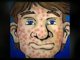 Acne Prevention Tips - Combating Your Skin Problem