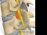 Cervical Spine Pathology Intervertebral Disc Sequestration patient education companies