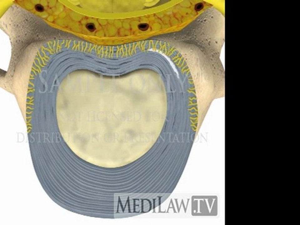 Cervical Spine Pathology Inter-vertebral Disc Annular Circumferential Tear litigation graphics