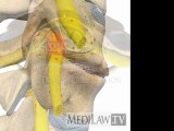 Cervical Spine Pathology Intervertebral Degenerative Disc Osteo-arthritis Disease Bone Spondylosis litigation 3D animations
