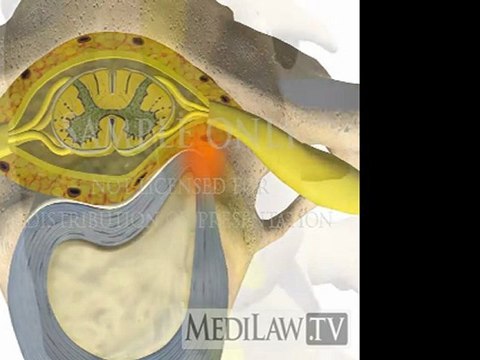 Cervical Spine Pathology Intervertebral Disc Protrusion patient education graphics