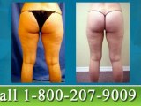 Tampa Thigh Liposuction - Leg & Knee Lipo in Tampa Bay