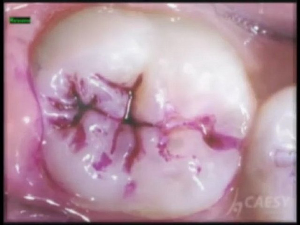 Dentist Glendale CA, What Are Dental Sealants? Dr. Kamran Sahabi