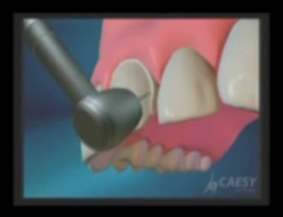 Dentist Glendale CA, What Are Porcelain Veneers? Dr. Kamran Sahabi
