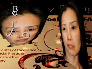 Remove Wrinkles With Face Lift in Las Vegas