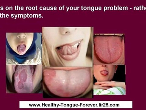 thrush symptoms in women - thrush symptoms in men - thrush symptoms in adults