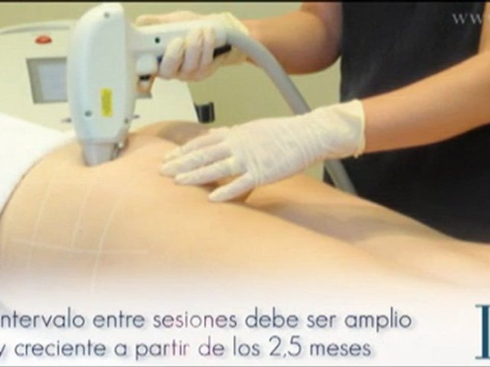 12 Consejos para la Depilación Médica Láser