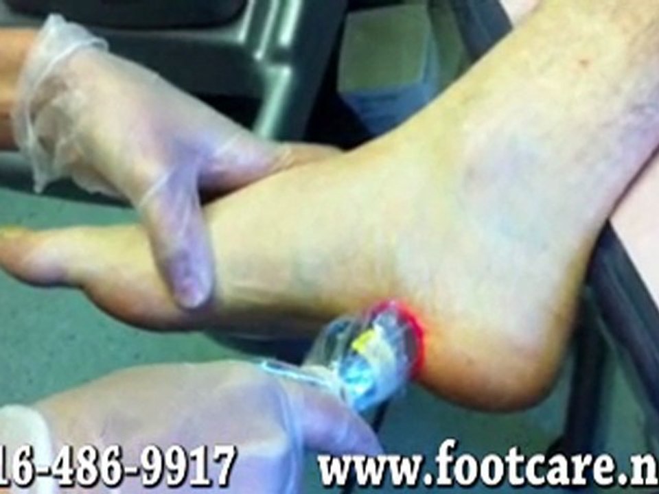 Laser Therapy for Foot Pain - Podiatrist Toronto, ON