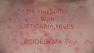 Natural Remedy For Urticaria