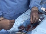 Carotid Artery Stenting .Flow Reversal for Carotid Protection. www.incathlab.com